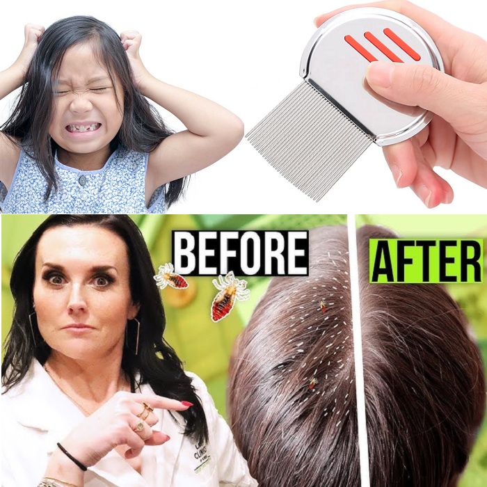 স্টেইনলেস স্টিলের উকুন অপসারণের চিরুনি, Stainless Steel Lice Removal Comb 1